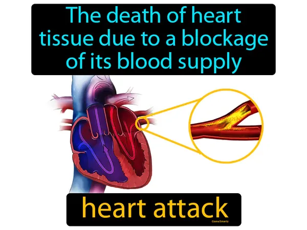 the death of heart tissue due to a blockage of its blood supply